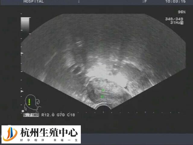 子宫内膜三线征完整提示内膜容受性好