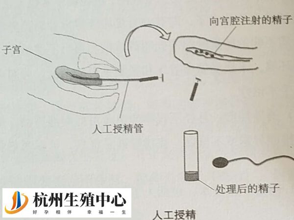 人工授精本身收费大约每次在1000元左右