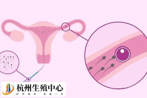 杭州人工授精流程简单